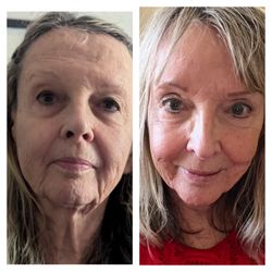 Divine Contours - A different modality used for anti-aging. Before on the left after PRP treatments on the right