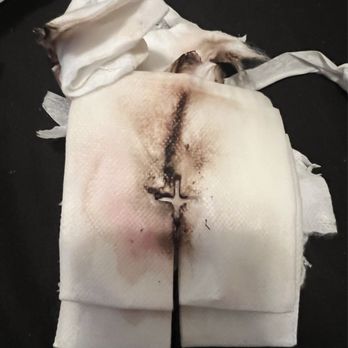 AdventHealth - Ocala - The gauze on my wound from an hr being on - Medical Centers Near Me - Ocala, Florida
