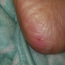 My heal was literally bleeding