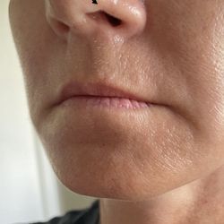 Sanaz Harirchian, MD - Retracted nostril