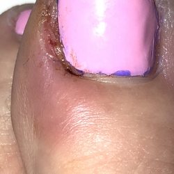 Haute Nail Spa - The infection that started within 24 hours of my pedicure