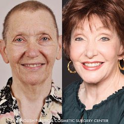 English Plastic and Cosmetic Surgery Center - Before & After Results of English Plastic and Cosmetic Surgery Center | Little Rock, AR