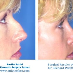 Parfitt Facial Cosmetic Surgery Center - Rhinoplasty Madison WI