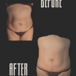 BayAreaVibe Body Sculpting & Post Op Care - Rf therapy/skin tightening