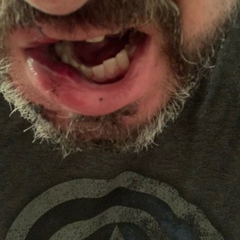 Johnston Dental Care - My teeth after my motorcycle accident. Dr. Johnston fixed this. I love him. - Pediatric Dentists Near Me - Grants Pass, Oregon