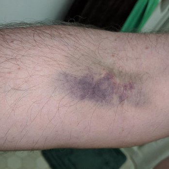 Quest Diagnostics - unacceptable treatment..This is 3 day after the Blood Draw.. - Laboratory Testing Near Me - Naples, Florida Quest Diagnostics - unacceptable treatment..This is 3 day after the Blood Draw.. - Laboratory Testing Near Me - Naples, Florida