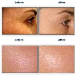 Radiant Skin Clinic - Minimizing Appearance of Pores