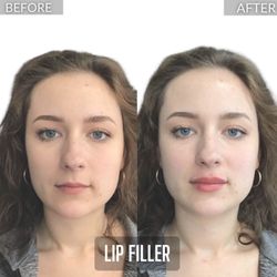 Juvly Aesthetics - Lip filler