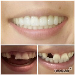 Elegantly Dental of MetroWest - Upper teeth crowns