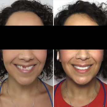 Bidwell Dental - Smile upgrade completed by Dr. Rob - General Dentistry Near Me - Folsom, California
