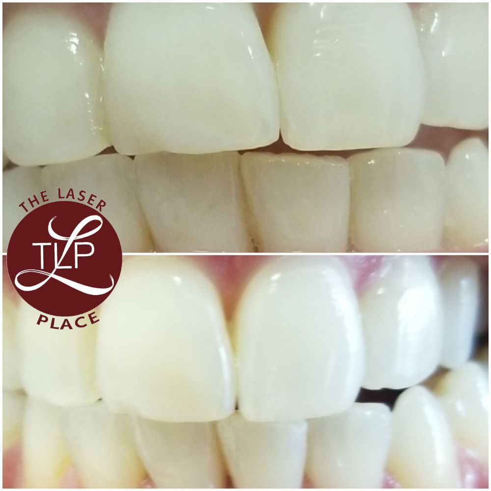 QUEENS LASER AND ELECTROLYSIS HAIR REMOVAL 8708 Justice Ave, Elmhurst, New York 30 Photos