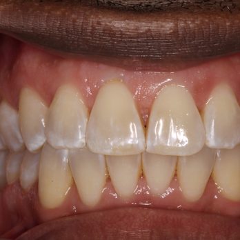 TrueCare Dentistry - After Invisalign Pic: The Invisalign system costs about the same as traditional braces, with even more benefits. - Cosmetic Dentists Near Me - Cary, North Carolina TrueCare Dentistry - After Invisalign Pic: The Invisalign system costs about the same as traditional braces, with even more benefits. - Cosmetic Dentists Near Me - Cary, North Carolina
