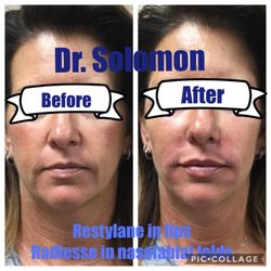 Solomon Cosmetic Center - Dermal fillers in lips and nasolabial folds