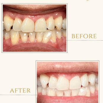 Modern Glo - This is a photo of my before and after teeth whitening. I went form a shade 18 to a 10 being my first session. I am a satisfied client. - Teeth Whitening Near Me - Hanford, California