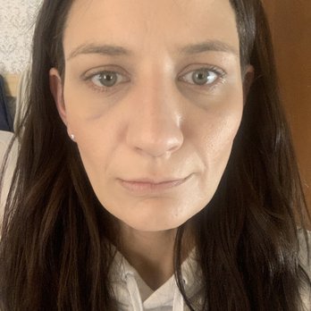 Jay Calvert, MD - 1 week after surgery - Cosmetic Surgeons Near Me - Beverly Hills, California Jay Calvert, MD - 1 week after surgery - Cosmetic Surgeons Near Me - Beverly Hills, California