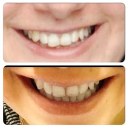 GLOW Dental - Teeth Contouring (two front teeth) by Glow Dental. VERY happy with my results. Changed my smile!!!