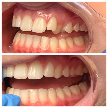 Smile Solutions Dentistry - Invisalign correction of the canine - Cosmetic Dentists Near Me - Tustin, California