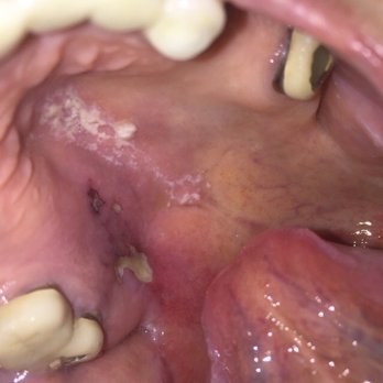 Bash Dental - This is what Dr. Bash did. He hammered me with rapid fire injections, injected bleach into my sinus cavity . - Cosmetic Dentists Near Me - Doylestown, Pennsylvania