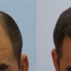 Carolina Hair Surgery