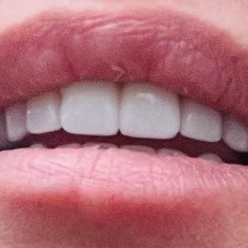 Washington State Prosthodontics - Cosmetic Dentists Near Me - Bellevue, Washington Washington State Prosthodontics - Cosmetic Dentists Near Me - Bellevue, Washington