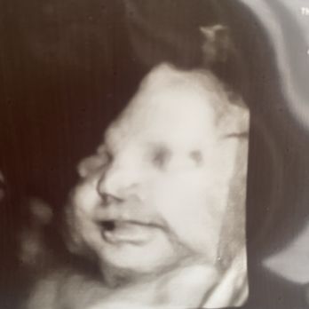Kicks and Giggles - 3D 33w2d - Ultrasound Imaging Centers Near Me - Santa Rosa, California Kicks and Giggles - 3D 33w2d - Ultrasound Imaging Centers Near Me - Santa Rosa, California