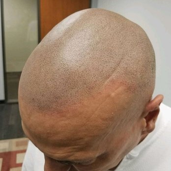 Micro Hair Tattoo Mht Soft Broken Hairline With Scatter Of