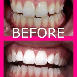 Maui Whitening of Music City - Real Clients, Real Results