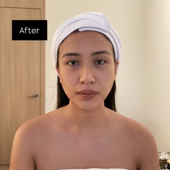 Genesys Laser Clinic - After - Laser Hair Removal Near Me - New York, New York Genesys Laser Clinic - After - Laser Hair Removal Near Me - New York, New York