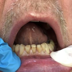 Before treatment of 4 lower anterior damaged teeth