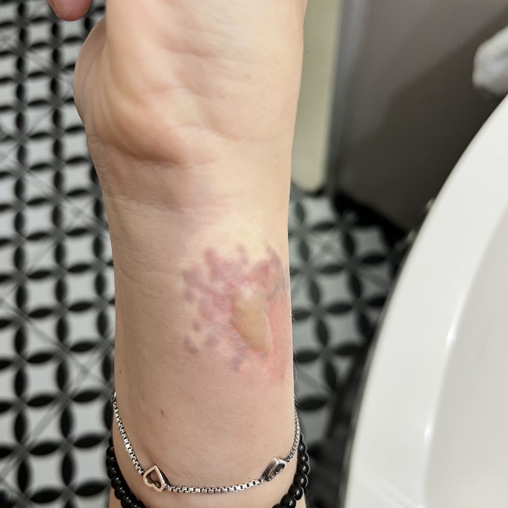 A&E 2020 - Blisters and burn from tattoo removal at A&E - Laser Hair Removal Near Me - East Syracuse, New York A&E 2020 - Blisters and burn from tattoo removal at A&E - Laser Hair Removal Near Me - East Syracuse, New York