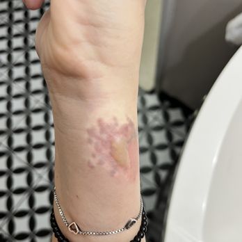 A&E 2020 - Blisters and burn from tattoo removal at A&E - Laser Hair Removal Near Me - East Syracuse, New York