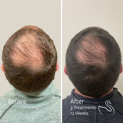 The Skin Center - Hair Restoration with LaseMD Ultra results at The Skin Center.
