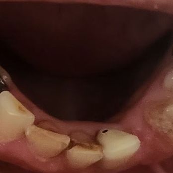 Weeki Wachee Dental Care - The horrible staining of the teeth I have left & the silver amalgam I was supposed to have replaced w/white ones. - General Dentistry Near Me - Weeki Wachee, Florida