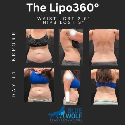 Lipo 360º - Non-surgical Lipo 360º treats abs, sides and back for an amazing 360º body sculpting experience. Guaranteed to reduce waistline 2-5 inches in 1 day. Minimal downtime and superior skin tightening. Lipo 360º - Non-surgical Lipo 360º treats abs, sides and back for an amazing 360º body sculpting experience. Guaranteed to reduce waistline 2-5 inches in 1 day. Minimal downtime and superior skin tightening.