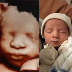 3DBabyVu - Before & After 5D Ultrasound
