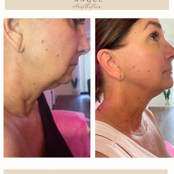 Angel Aesthetics - Body Contouring Near Me - Sacramento, California Angel Aesthetics - Body Contouring Near Me - Sacramento, California