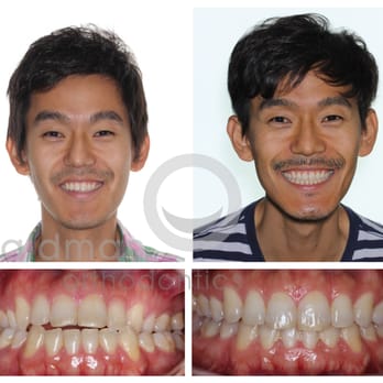 Waldman Orthodontics - November 2015 Smile of the Month - Orthodontists Near Me - Beverly Hills, California Waldman Orthodontics - November 2015 Smile of the Month - Orthodontists Near Me - Beverly Hills, California