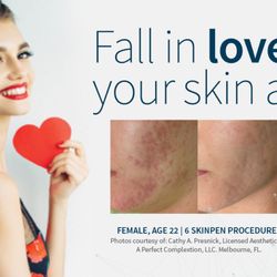 De Ramon Plastic Surgery Institute - Microneedling can improve skin tone, texture and fine lines!