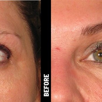 Advanced Skin Medspa - ULTHERAPY "BROW-WOW" LID LIFT - Medical Spas Near Me - Newburgh, New York