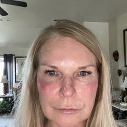 Reaction to chemo! Reaction to chemo!