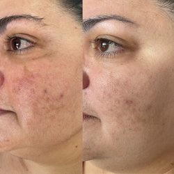 Adriana Rodriguez Med Spa - Hyperpigmentation after one treatment