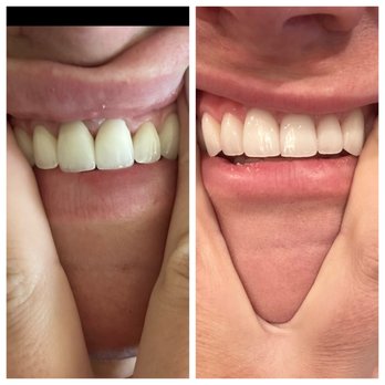 Dr. Jorg-Peter Rabanus - Left-Before (previously botched by old dentist) Right- After by Dr. R. you can see how much healthier and happier my gums are! - Cosmetic Dentists Near Me - San Francisco, California Dr. Jorg-Peter Rabanus - Left-Before (previously botched by old dentist) Right- After by Dr. R. you can see how much healthier and happier my gums are! - Cosmetic Dentists Near Me - San Francisco, California