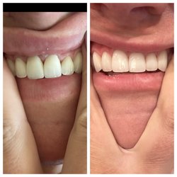 Dr. Jorg-Peter Rabanus - Left-Before (previously botched by old dentist) Right- After by Dr. R. you can see how much healthier and happier my gums are!