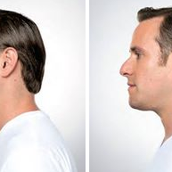 Thaxton Plastic Surgery - Kybella before & after - Cosmetic Surgeons Near Me - Charleston, West Virginia Thaxton Plastic Surgery - Kybella before & after - Cosmetic Surgeons Near Me - Charleston, West Virginia