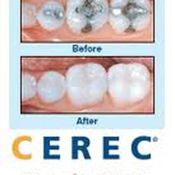 Park Circle Dental - Before and After with our CEREC machine! Check us out on Yelp, Facebook and Twitter, or on the web at www.parkcircledental.com.