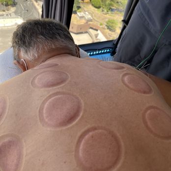 Inner Chi Hawai'i - After Cupping - Acupuncture Near Me - Honolulu, Hawaii