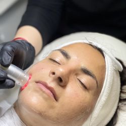 Omni Beauty Spa - Radio Frequency (RF) Treatment