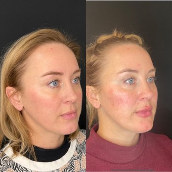 Aesthetics by Heather Weltner - Filler to Cheeks, Chin and Lips - Medical Spas Near Me - Austin, Texas Aesthetics by Heather Weltner - Filler to Cheeks, Chin and Lips - Medical Spas Near Me - Austin, Texas