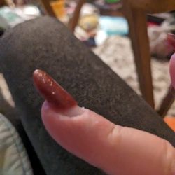 Sushila's Beauty Care - Finger had a blood blister at the cuticle and skin all dried and red.