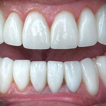 2thbar by Dr B - 21 Porcelain Restorations (Veneers & Crowns) 1 Life Changing Smile Transformation - Cosmetic Dentists Near Me - Lone Tree, Colorado
